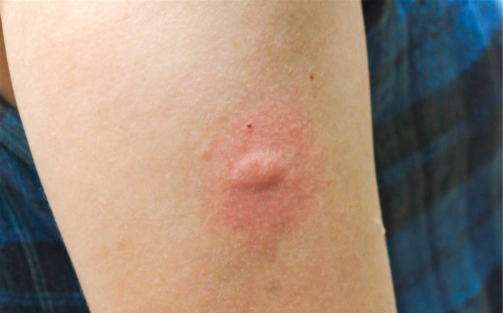 什么是丘疹性荨麻疹？