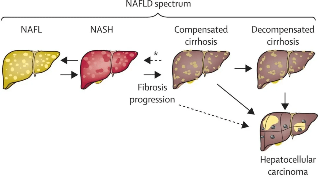 從脂肪肝到肝硬化肝癌有多遠還要警惕哪些健康問題