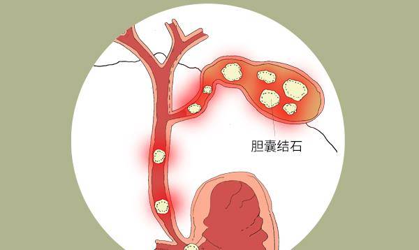 胆摘除的人口_胆摘除照片(3)