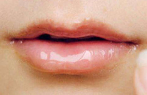 为什么剥脱性唇炎最难治疗