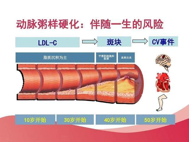 是什么原因引起血管狭窄 9830c0115f874a6ebd50336692d32c29.jpeg