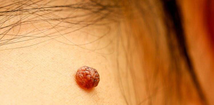 什么是黑色素瘤恶性的 1b194f1b562b42fbbd2d56abd857932e.jpeg