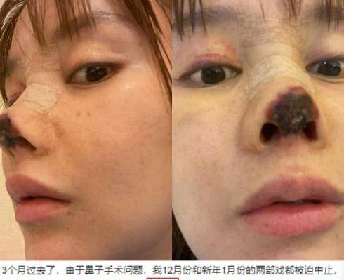 演员高溜整容失败后首现身,摘口罩露出整张脸,鼻翼缺损鼻尖红肿