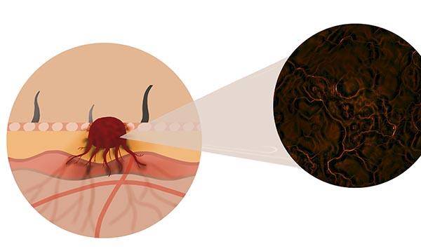 小淋巴细胞淋巴瘤严重吗 8acd255ec9094f8093ff3e99a7c5e1df.jpeg