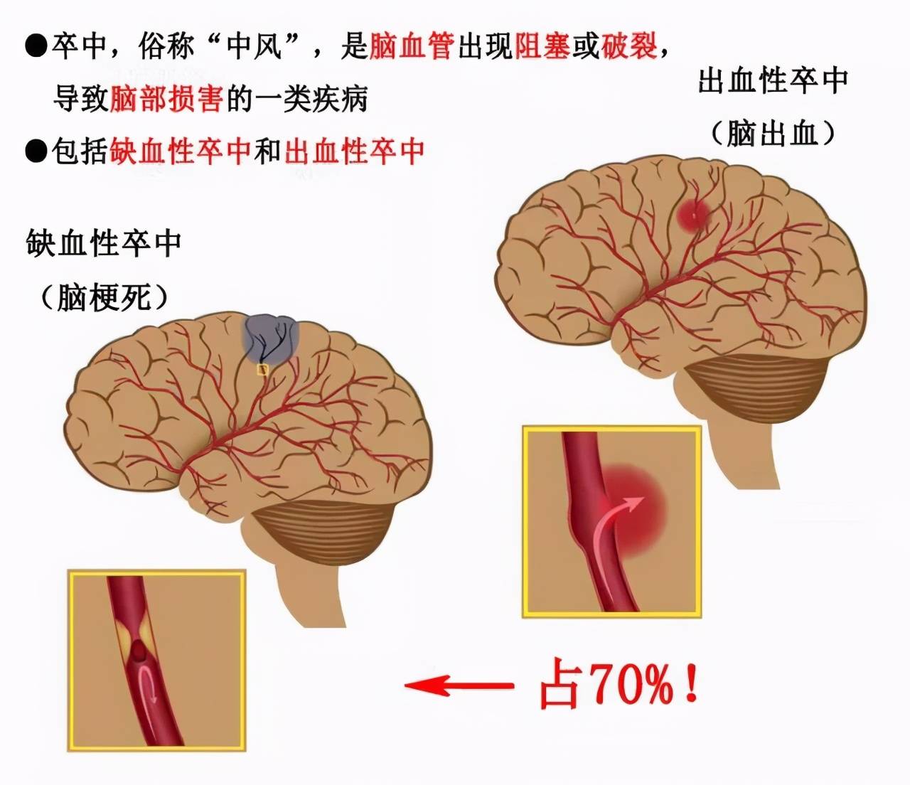 医生告诫:这几类人群易被脑卒中盯上,身体出现这些症状,要当心