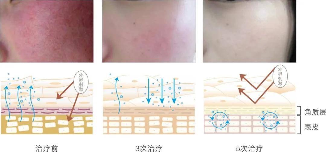 皮肤角质层受损能养回来吗