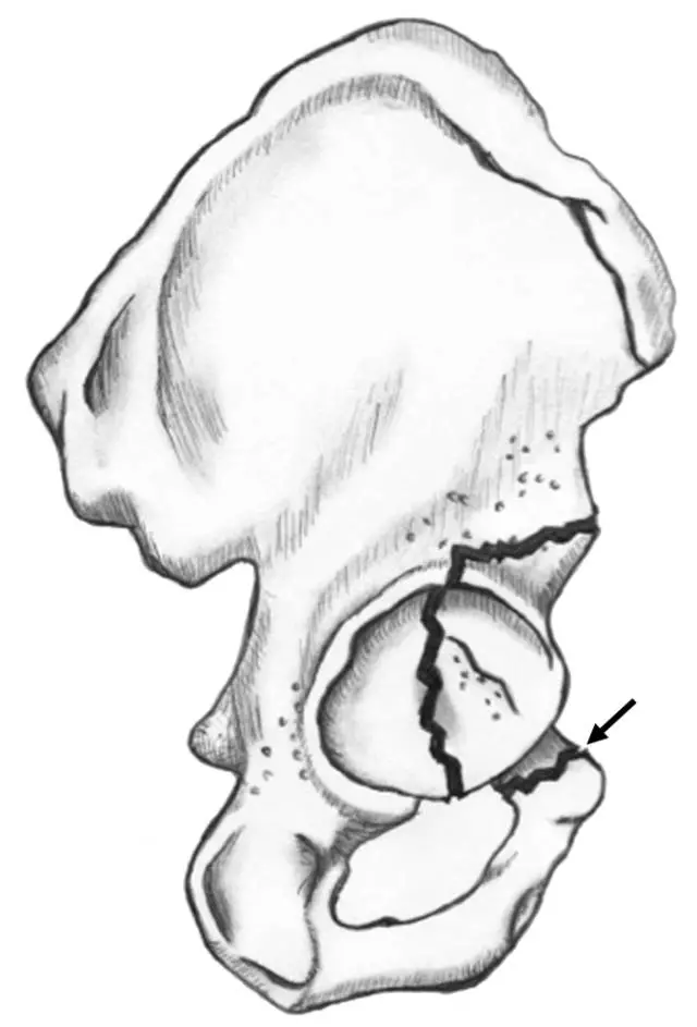 髋臼骨折的影像学表现_髂骨
