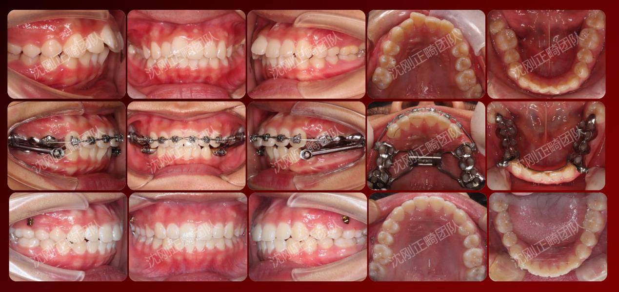 正雅gs技术与产系治疗伴颞下颌关病错颌畸形