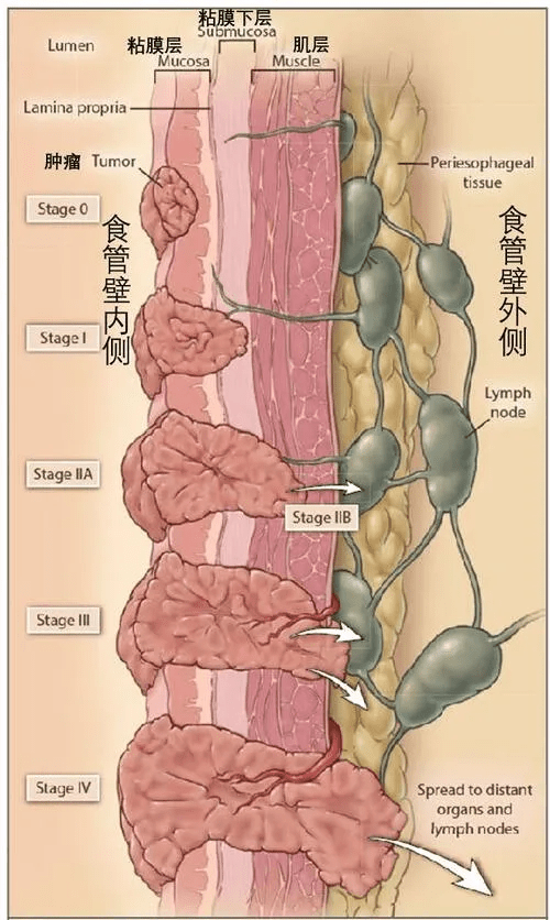 為什麼說食管癌是中國特色癌症