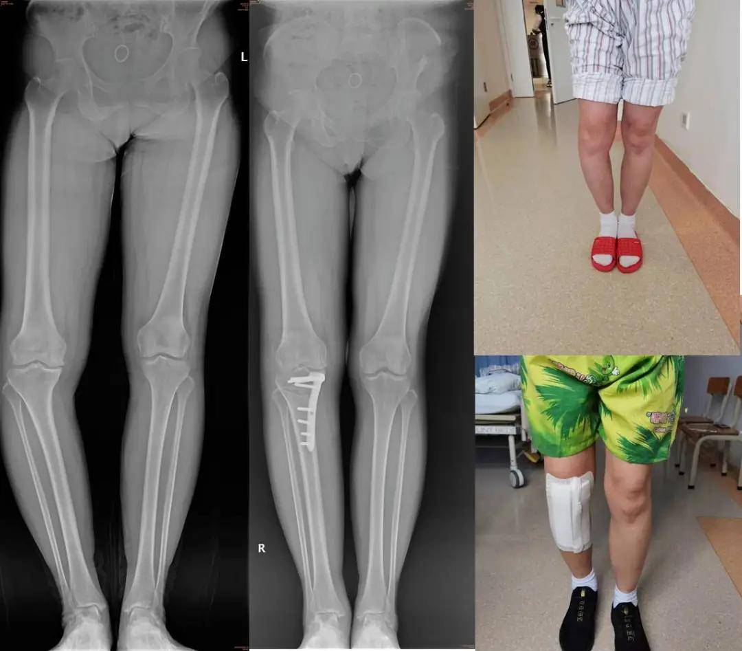 矫形术病情发展:患者从6年前起,患者逐渐出现了小腿的内翻畸形(o型腿)