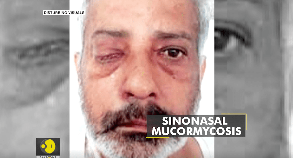 吓人美国9名新冠康复者患上巨舌症嘴装不下只能切除