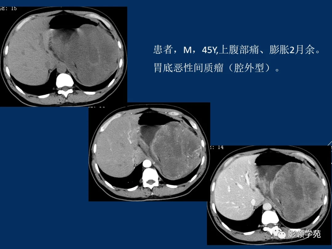 15個病例熟悉胃腸道間質瘤影像表現