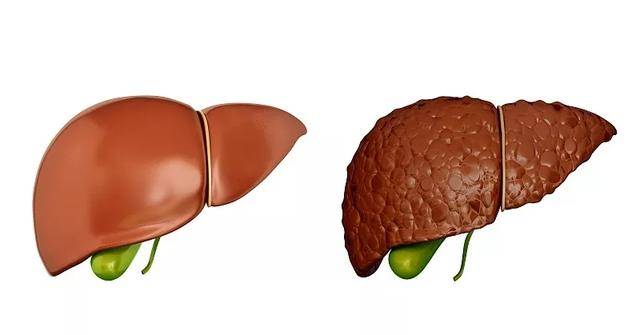 肝纤维化和肝硬化
