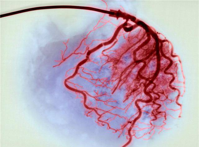 心脏造影怎么做视频全过程要多久 4d767552748f473eb15e0e8e196d76da.jpeg