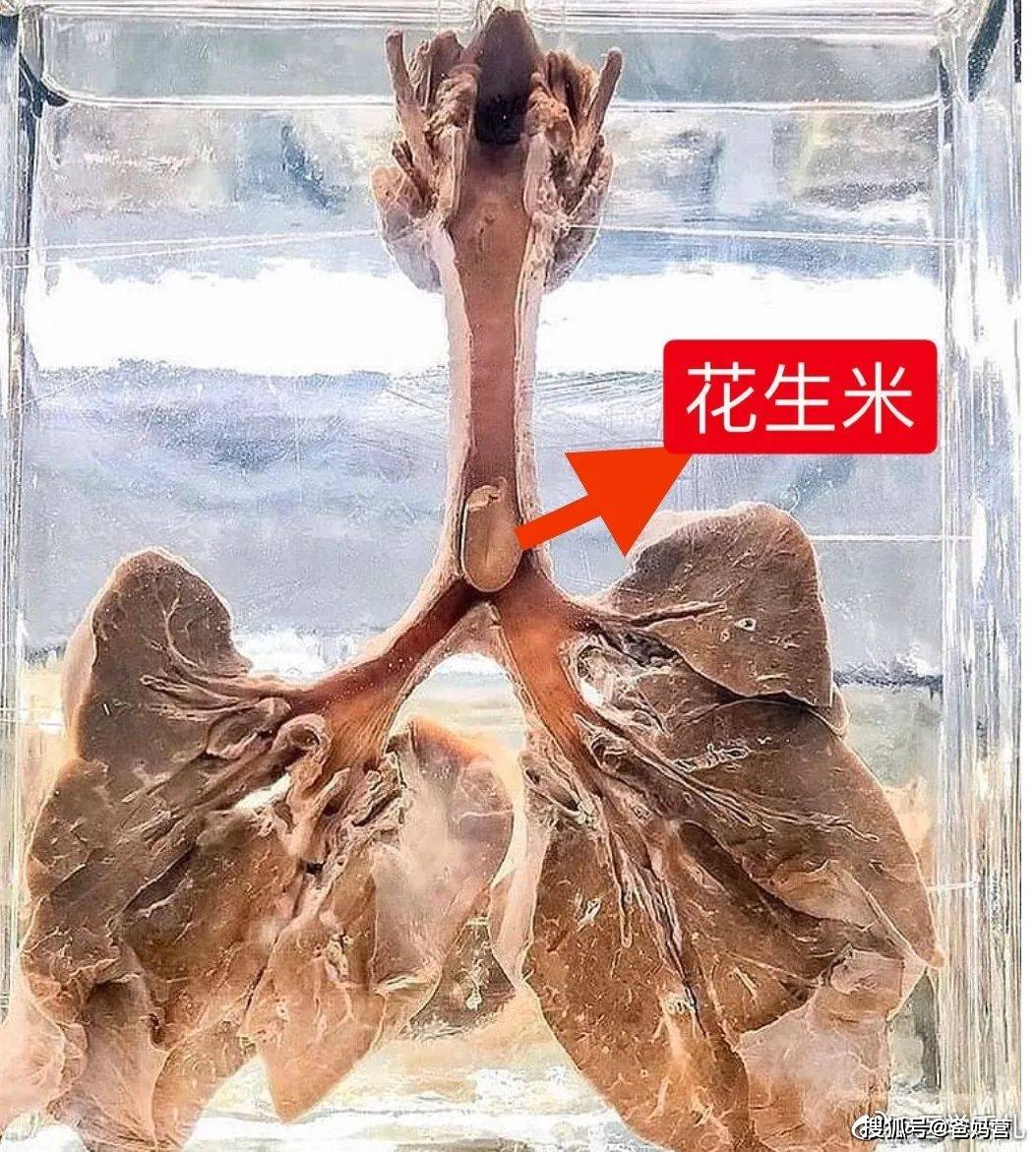 这是一个被花生噎死的孩子的肺解剖标本,气管里的那半颗花生米分外