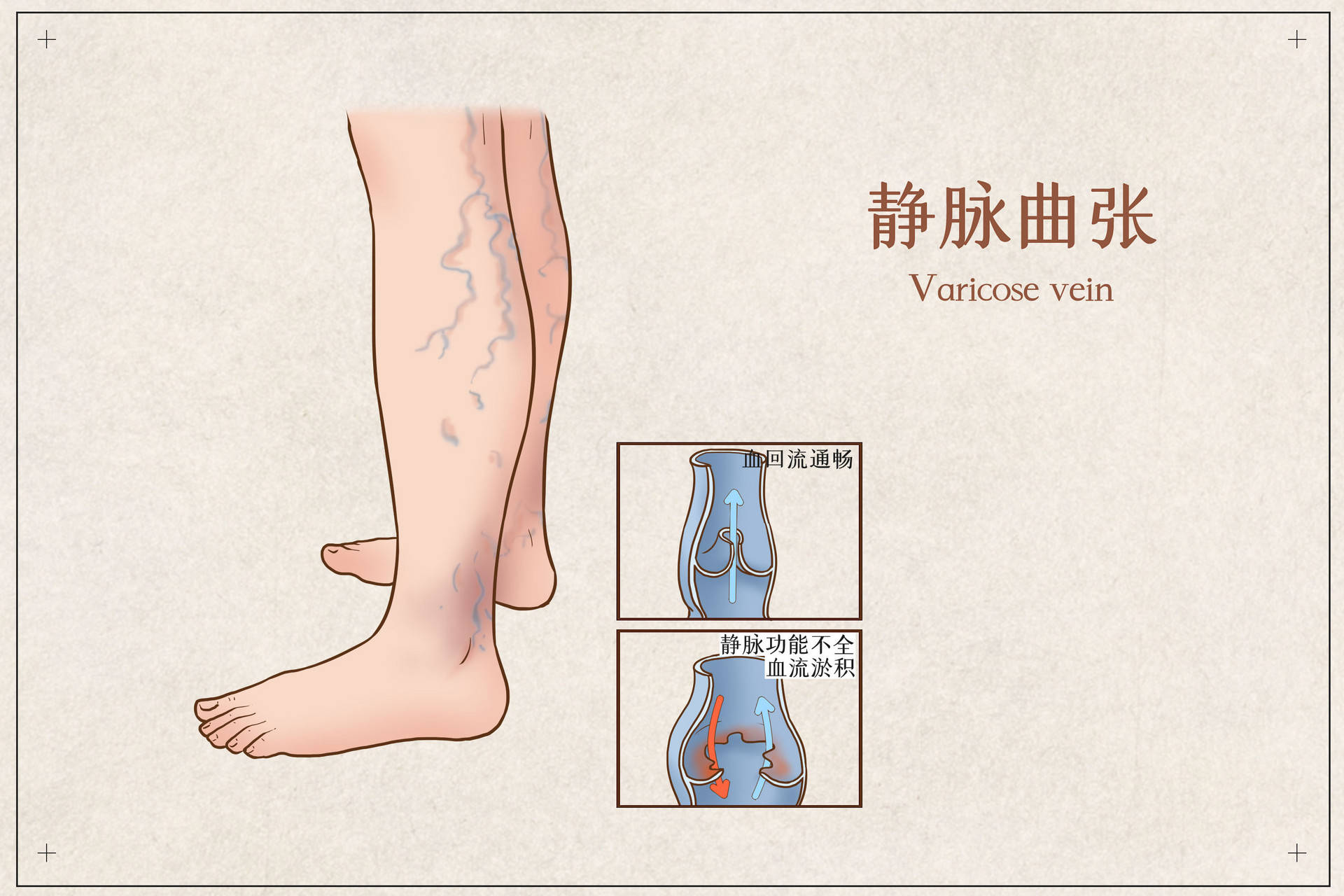 腿上血管擴張,出現蚯蚓狀的青筋?當心靜脈曲張