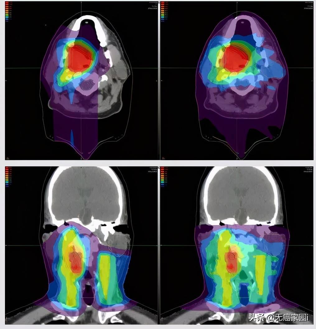 原创听不清看不见说不出口头颈癌选择质子治疗准没错