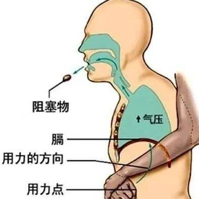 健康科普必學拯救百萬人生命擁抱的海姆立克急救法