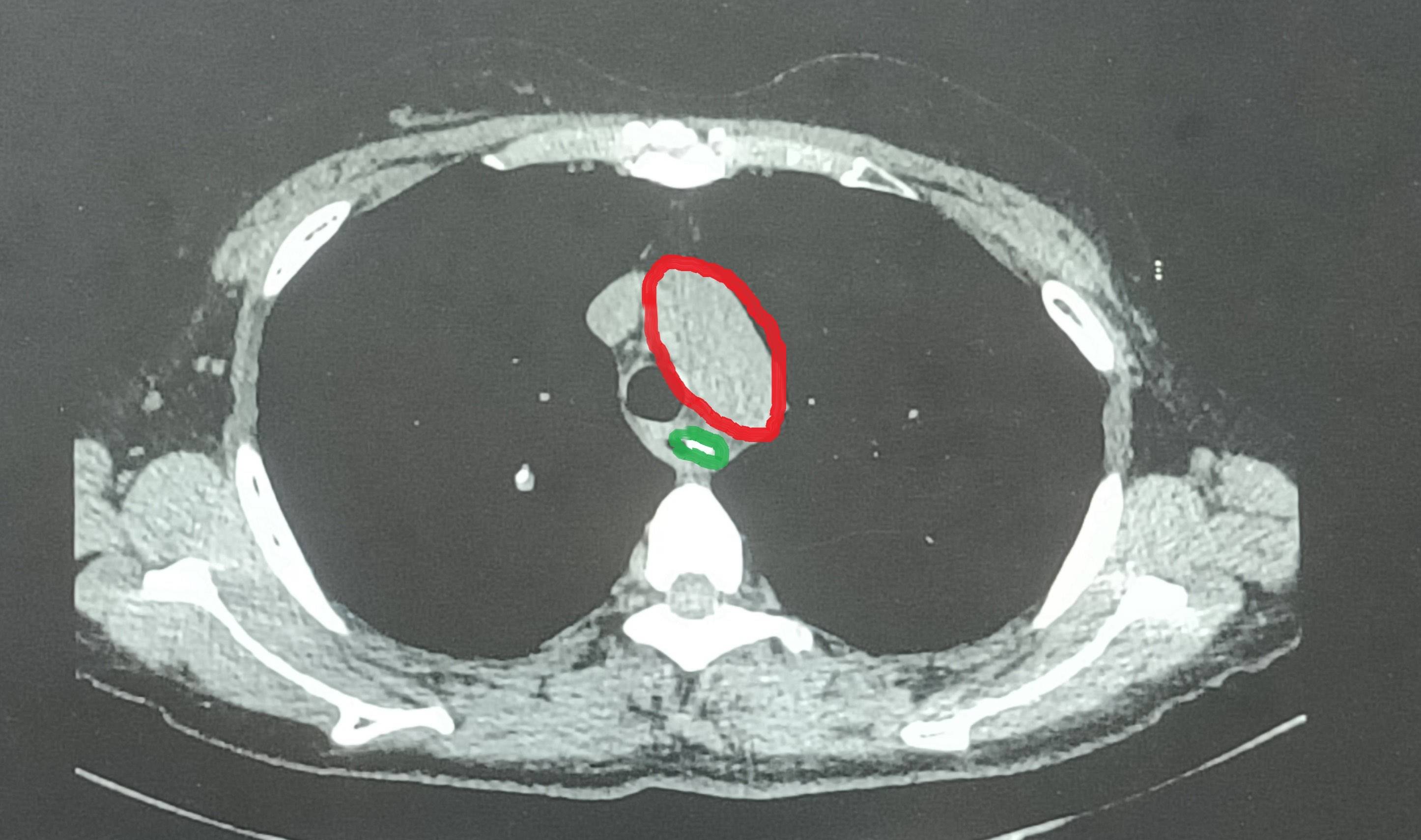 阿姨吃粽子"囫囵吞枣",被3厘米枣核卡住食道_异物