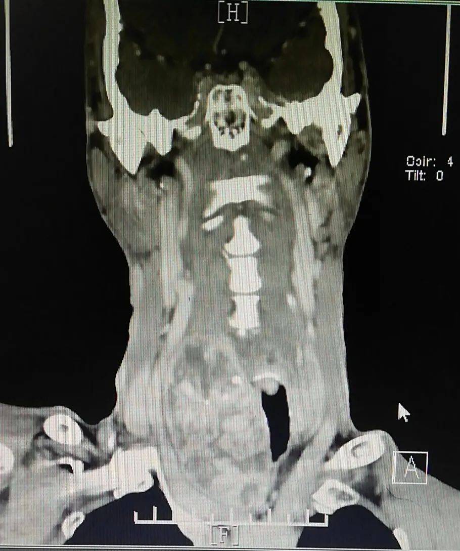 正興醫院普外科:完成一例巨大胸骨後甲狀腺腫物切除術