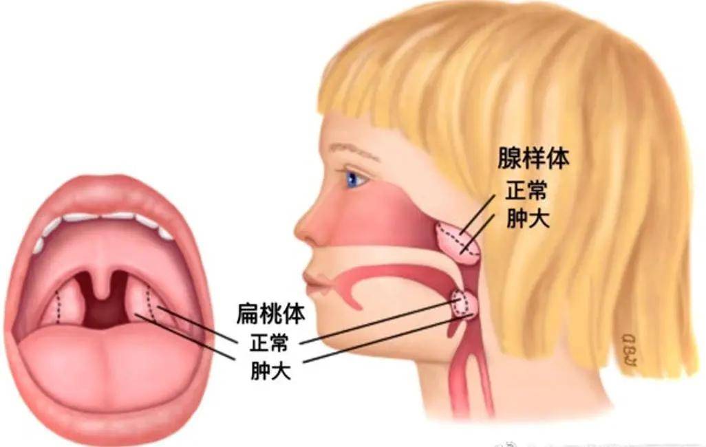 儿童打鼾最常见的病因是扁桃体与腺样体肥大.