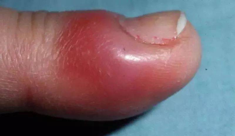 如何修甲沟炎指甲 0af0da55547c4f928c8ab9c9325f0f3c.jpeg