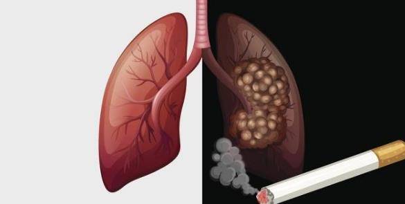 吃什么东西对肺部最好 f5cfb76169a14dd3afe76fed5fcaf6e7.jpeg