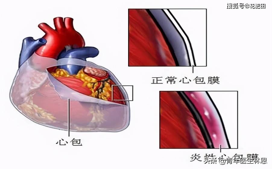 出现2级心包炎及心包积液时,可利用超声心动图严密监测积液的进展情况