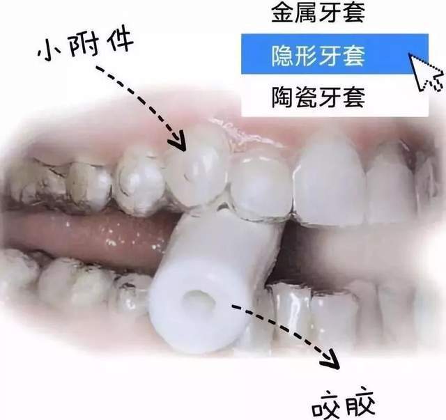 整牙就会牙套脸揭秘妖魔化牙套脸的真相