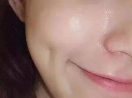 血管|光子嫩肤、皮秒、水光针怎么选？看完你就知道了