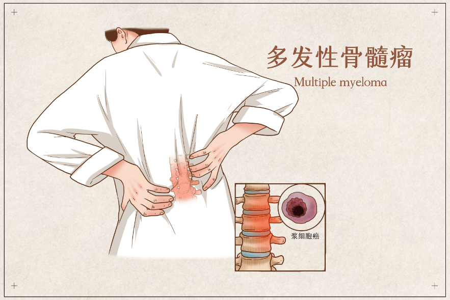 淋巴细胞|认识不常见的多发性骨髓瘤