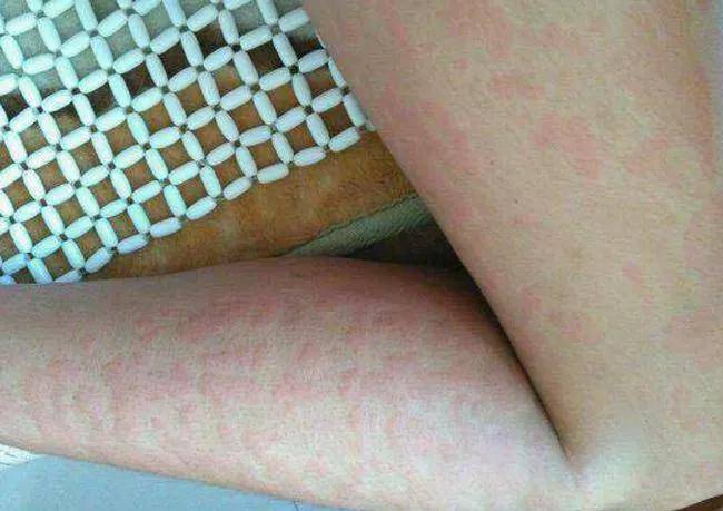 热性荨麻疹照片图片
