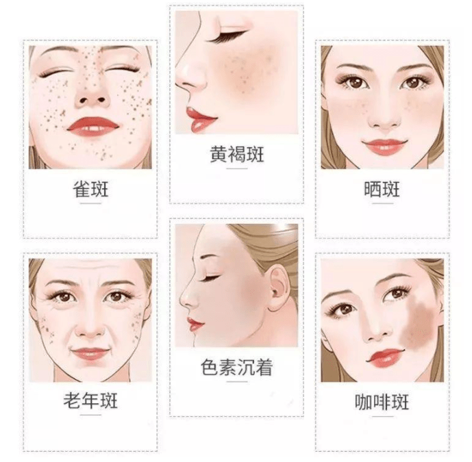 斑还在?祛斑从根源解决,"斑点"彻底消失对症很重要_色斑