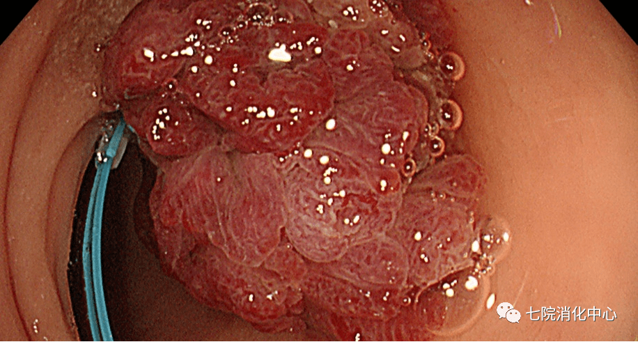 手术|结肠息肉怎么破？内镜帮您来搞定