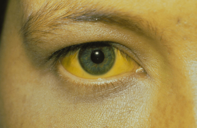 冰菊|被列入“伤身名单”的3种早餐,提醒:肝不好的人,尽可能少吃