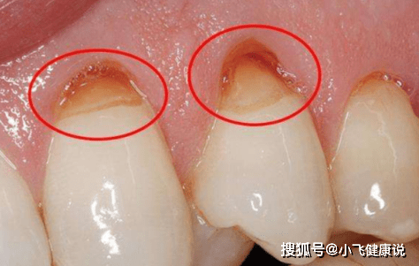 什么样是牙龈萎缩 7f720e479ff94f13b983a1e8a45cb280.png