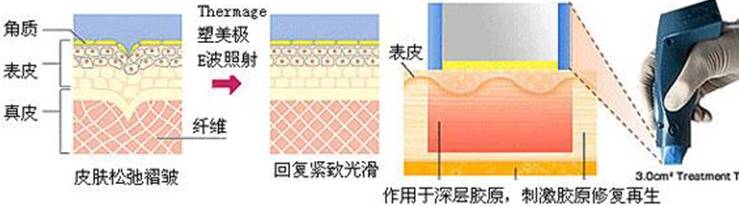 玛吉|热玛吉真的有用吗？让我们看看