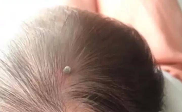江西南昌一个刚出生4天的宝宝头皮上突然出现了一个像痣一样的东西