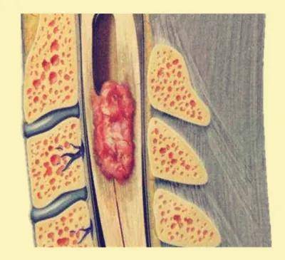 症状|腰腿疼痛反复发作？背后可能暗藏椎管内肿瘤的杀机 ！！！