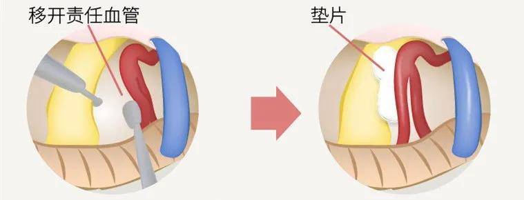 天下|号称“天下第一痛”的三叉神经痛究竟有多痛？答案在这里！