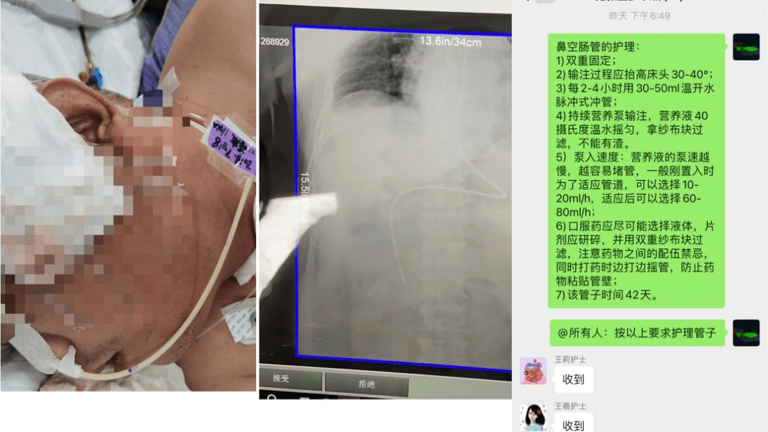 团队|加强营养 促进康复 ——记神经外科护理团队成功开展床旁盲探鼻空肠管置入术