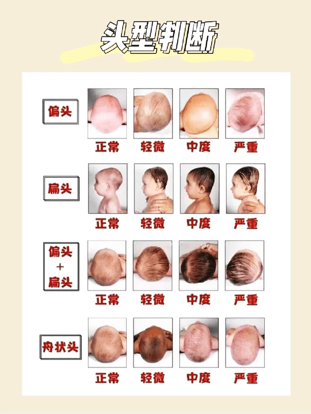 状头|如何成功睡出小圆头？舟状头的逆袭之路！