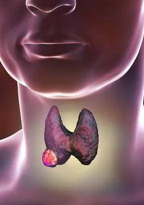 这种情况也就是说,一般情况下,如果甲状腺b超提示甲状腺结节边界不清