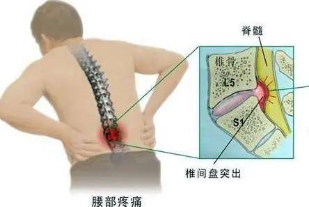 诊断|腰椎间盘突出=腰椎间盘突出症？NO！两个有着天壤之别!