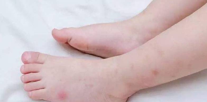 浆液|脚上出现这4个症状,说明你已经惹上糖尿病了,务必提高警惕!