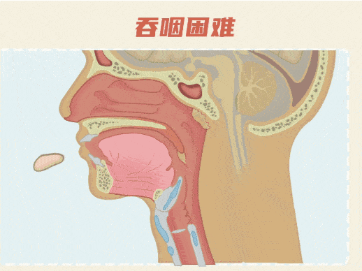 神经系统病变引起的吞咽障碍症状该如何进行康复训练?