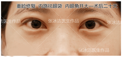 眼睛|张冰洁医生关于【双眼皮修复】| 重睑线浅、不对称、厚重感的双眼皮案例分析~