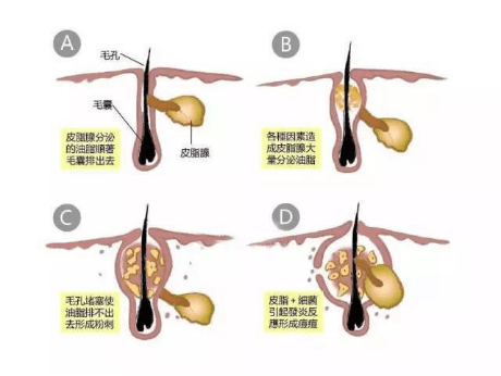 毛周|学生党常见的皮肤问题，首先分清症状，再谈正确护肤