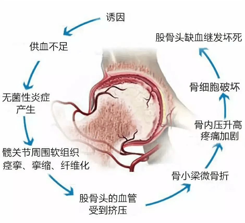 膝盖总疼为什么说是股骨头坏死