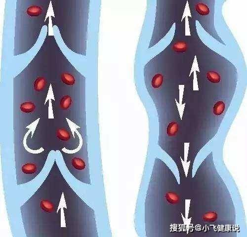 蓝色血管是静脉吗 032b64c9d3e64ecd9a2bfb4d1c4ced80.jpeg
